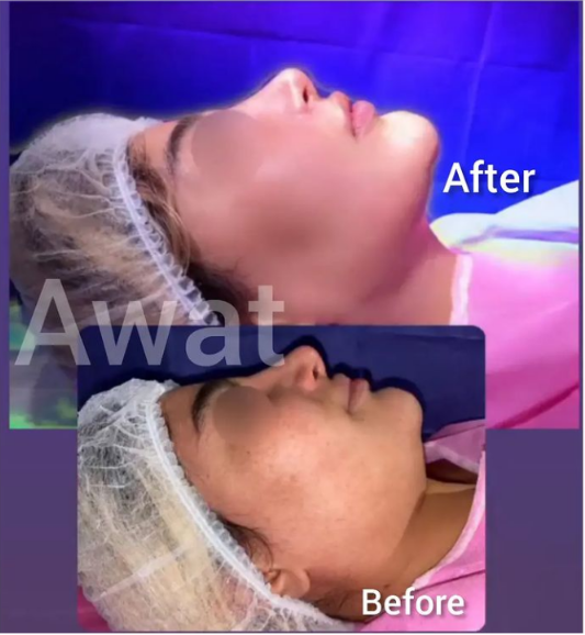 Buccal fat pad removal contouring surgery