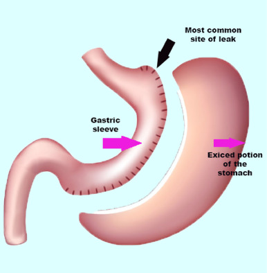 Gastric sleeve in Iran