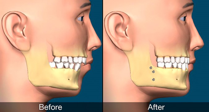 Chin cosmetic surgery methods