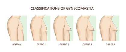 Recovery from gynecomastia surgery