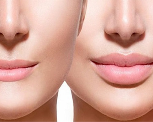 Central lip lift vs. lip fillers
