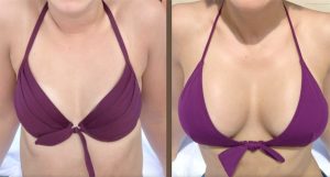Before & After Photos of Breast augmentation in Iran