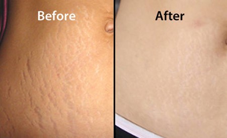 Kinds of stretch marks treatments