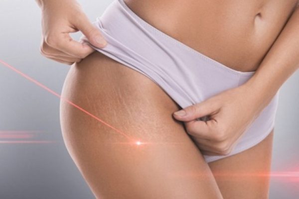 Laser Treatment for stretch marks