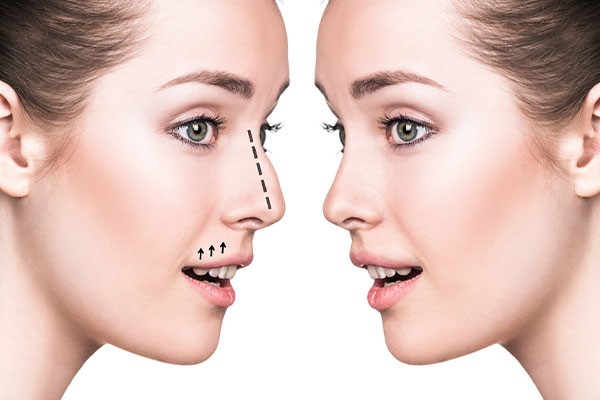 best countries for nose job