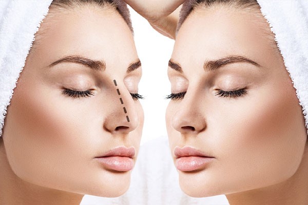 care after rhinoplasty surgery