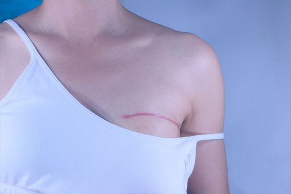 After breast cancer surgery care