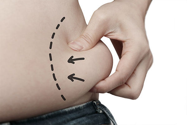 liposuction benefits for type 2 diabetes